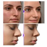 Eelhoe Nose Shaper Nose Shape Shaper Nose Shape Shaper Nose Shape Shaper Nose Shape Shaper - Image 2