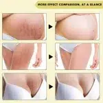 Stretch Mark Removal Oil Removes Postpartum Pregnant Women Scar Repair Obesity Stretch Mark Anti-Aging Firming Serum Skin Care - Image 2