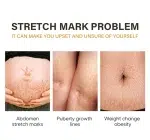 Stretch Mark Removal Oil Removes Postpartum Pregnant Women Scar Repair Obesity Stretch Mark Anti-Aging Firming Serum Skin Care - Image 9