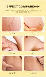 Stretch Mark Removal Oil Removes Postpartum Pregnant Women Scar Repair Obesity Stretch Mark Anti-Aging Firming Serum Skin Care - Image 7